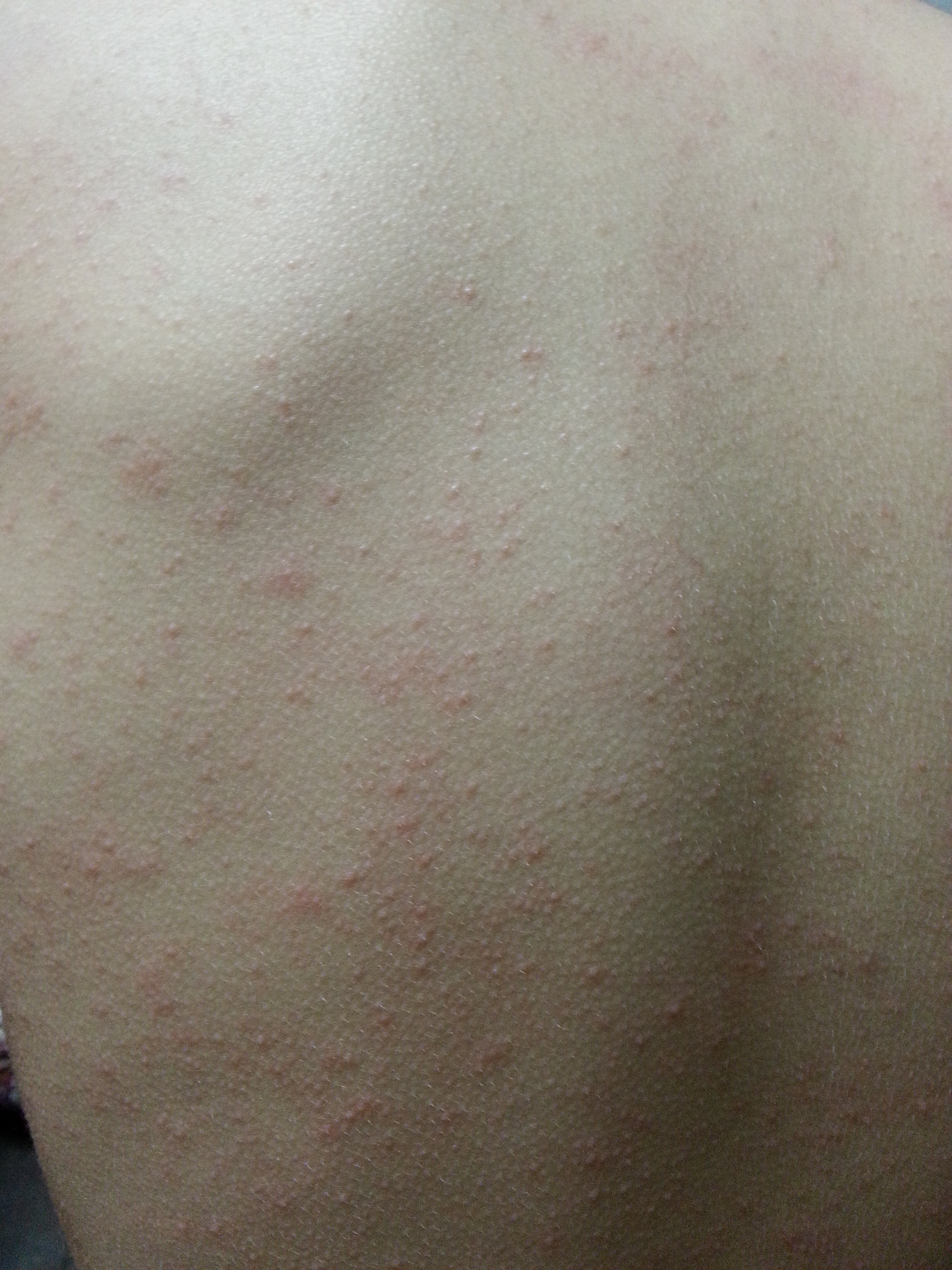 子供の発疹が全身にあるけど熱はない 赤いぶつぶつは溶連菌 分からないこと みんなで調べれば怖くない